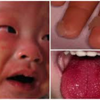 Hội chứng viêm đa hệ thống giống bệnh Kawasaki ở trẻ mắc Covid-19 là gì?