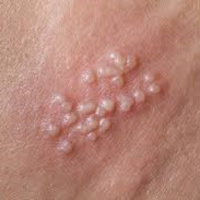 Mụn rộp sinh dục và những ảnh hưởng đến chuyện chăn gối (P3)