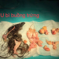 Loại u có thành phần bao gồm răng, tóc, da, bì gây bệnh lý vô sinh hiếm muộn ở nữ giới