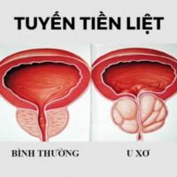 Phì đại tuyến tiền liệt - nỗi ám ảnh của các quý ông