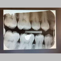 Recording a visit to the dentist in ambisonic