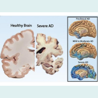 4 Your Health w/ Marsha Thadison (Alzheimer and Embrace Hospice)