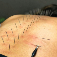 Acupuncture
