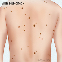 Patients’ Views About Self-examination After Treatment for Localized Melanoma