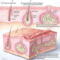 Comparative Overall Comorbidity Burden Among Patients With Hidradenitis Suppurativa