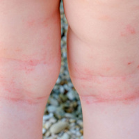 Association Between Atopic Dermatitis and Educational Attainment in Denmark