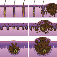 Prognostic Gene Expression Profiling in Cutaneous Melanoma