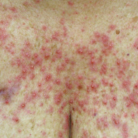 Dermatologic Care in Oncology and Patterns of Prophylaxis for EGFRi-Associated Skin Toxicity