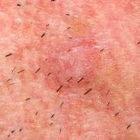 Perineural Invasion of Cutaneous Squamous Cell Carcinoma