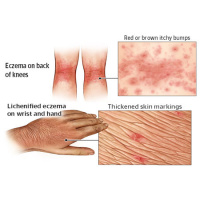 Association of Inadequately Controlled Disease With Patient-reported Disease Burden in Atopic Dermatitis