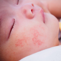 Assessment of Sleep and Exhaustion in Mothers of Children With Atopic Dermatitis