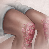 Psoriasis