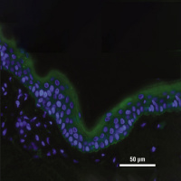 Milestone Clinical Events in Patients From North America With Epidermolysis Bullosa