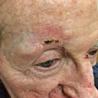 Multiple vs First Incidence of Cutaneous Squamous Cell Carcinoma and Estimation of Future Incidences