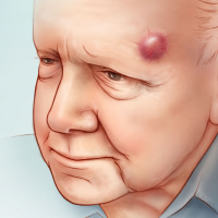 Recurrence and Mortality Risk of Merkel Cell Carcinoma by Cancer Stage and Time From Diagnosis
