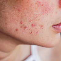 Patient Perspectives on the Lived Experience of Acne Among Adult Women
