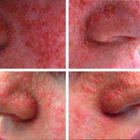 Topical Rapamycin in Patients With Facial Angiofibromas