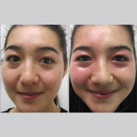 Effect of Topical Brimonidine on Alcohol-Induced Flushing in Asian Individuals