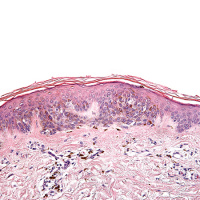 Risk of Melanoma in Moderately Dysplastic Nevi Excisionally Biopsied but With Positive Margins