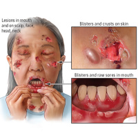 Factors Associated With Complete Remission After Rituximab Therapy for Pemphigus