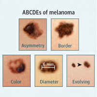 Age-Specific Incidence of Melanoma in the United States