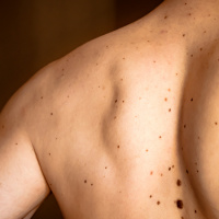 Association Between Sexual Orientation and Lifetime Prevalence of Skin Cancer in the United States