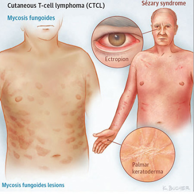 Jama Dermatology Author Interviews: Covering Research On The Skin, Its Diseases, And Their Treatment