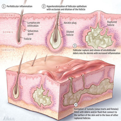 Jama Dermatology Author Interviews: Covering Research On The Skin, Its Diseases, And Their Treatment