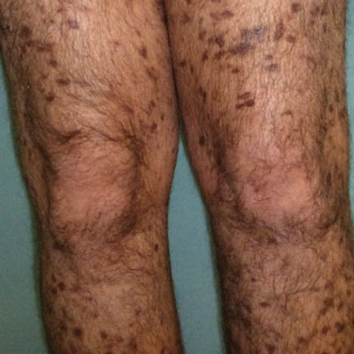 Jama Dermatology Author Interviews: Covering Research On The Skin, Its Diseases, And Their Treatment