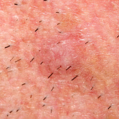 Jama Dermatology Author Interviews: Covering Research On The Skin, Its Diseases, And Their Treatment