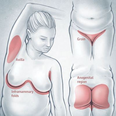 Jama Dermatology Author Interviews: Covering Research On The Skin, Its Diseases, And Their Treatment