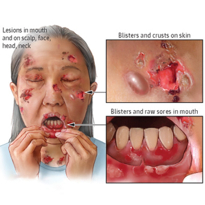 Jama Dermatology Author Interviews: Covering Research On The Skin, Its Diseases, And Their Treatment
