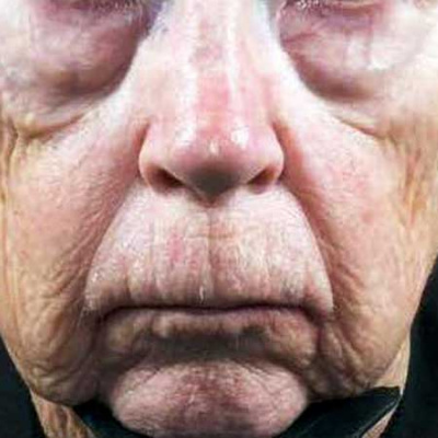 Jama Dermatology Author Interviews: Covering Research On The Skin, Its Diseases, And Their Treatment