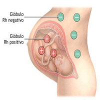 Enfermedad hemolítica del recién nacido