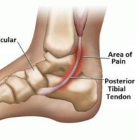RE-EVAL Xtreme Footwerks Clinical Condition Series: Posterior Tibialis Tendonitis
