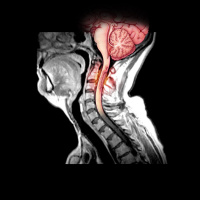 Could We Be On The Verge Of A Vaccine For MS?