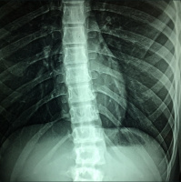 RAF289: Weight Loss and Spinal Meandering