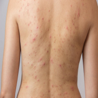 Dealing with adult acne