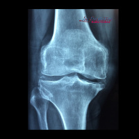 T. 05 Cap. 51 Dra. Giselle Lozano Alcocer OSTEOPOROSIS, en Los Productores.