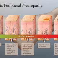Holistic Health Evaluation for Reversing Neuropathy - Fargo, ND