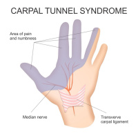 Carpal Tunnel Syndrome