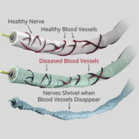 Reversing Neuropathy: A Holistic Health Assessment