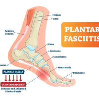 Plantar Fasciitis