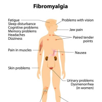 Fibromyalgia