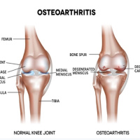 Osteoarthritis