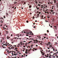 3 Dead From Mysterious Nipah Virus In Kerala, Centre Sends Team