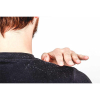 Home Remedies To Get Dandruff Free Hair