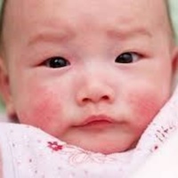 Chăm sóc da để trẻ không bị chàm, ngứa, nẻ trong thời tiết khô lạnh