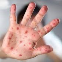 Tẩy chay văc-xin, nhiều dịch bệnh có thể quay trở lại