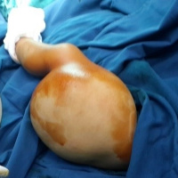 U bạch huyết ở trẻ em có nguyên nhân từ quá trình mang thai